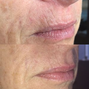 Bovenlip resultaat na drie weken