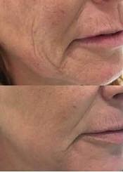 Huidverstrakking na een plasmapenbehandeling