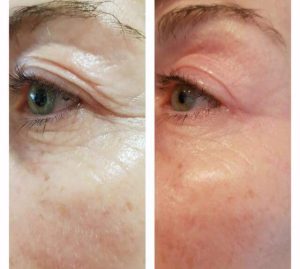 Bovenooglid en kraaienpootjes voor en na