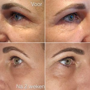 Onderooglid en kraaienpootjes voor en na