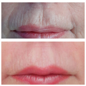 Bovenlip voor en na