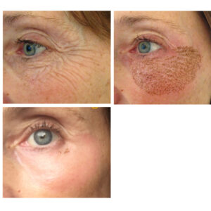 Voor, vlak na en twee weken na de behandeling